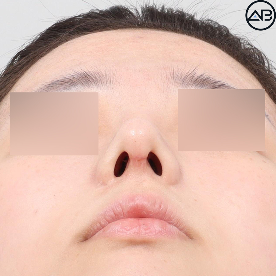 에이비성형외과 자려한코성형 케이스리뷰 관련 이미지 5