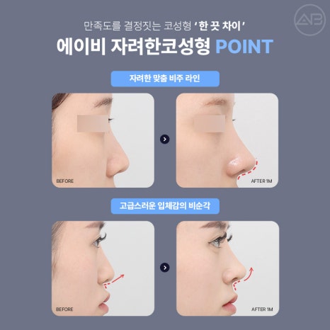 에이비성형외과에서 만나는 자려한 비주라인 코성형 관련 이미지 4