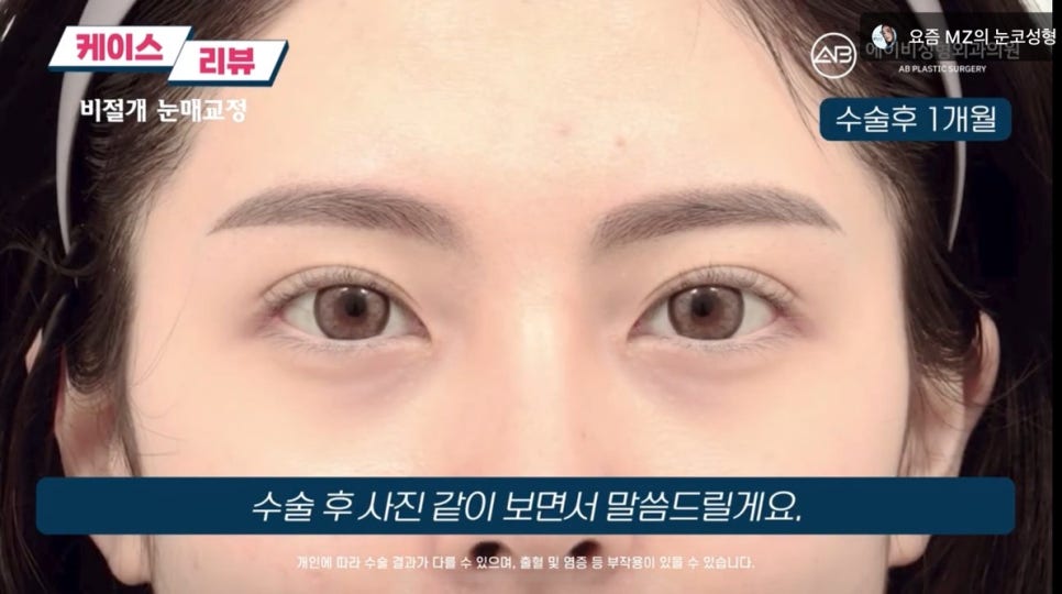 #AB Plastic Surgery #AB TV #Eye Surgery #Non-Incisional Ptosis Correction image 4