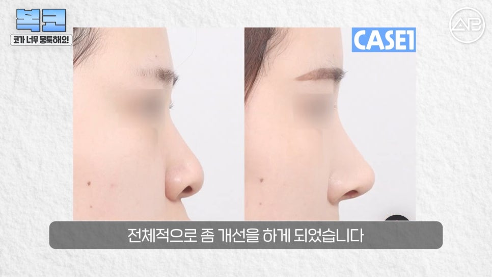 #에이비성형외과#에이비tv#코성형#복코성형 관련 이미지 15