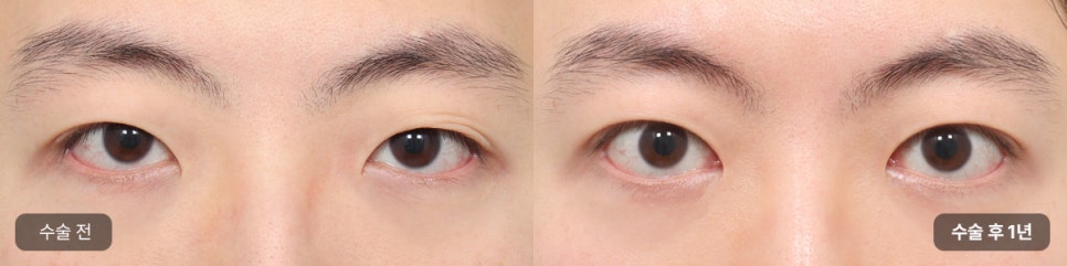 Key Points of Male Eye Surgery, Explained by AB! (Feat. Director Son Ji-hwan) image 4