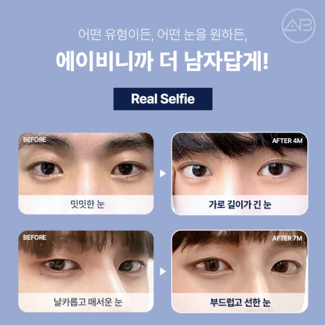 인상을 바꾸는 첫 시작, 에이비성형외과 남자눈성형 관련 이미지 3