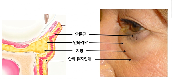 에이비성형외과 20대도 눈밑지방재배치가 필요할까? 불룩한 눈밑 원인과 해결방법 관련 이미지 1