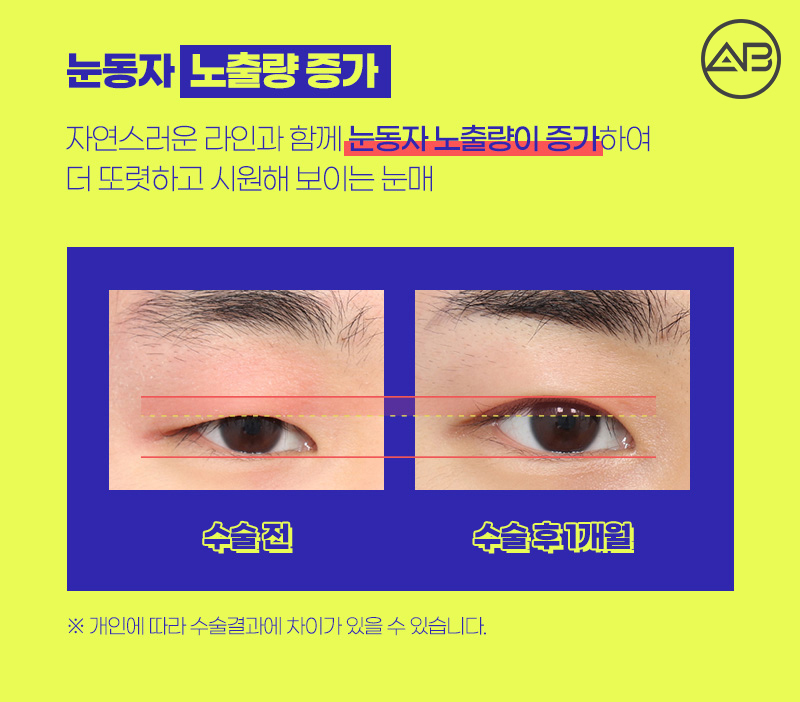 남자쌍수후기 시원하고 자연스럽게 에이비성형외과 관련 이미지 5