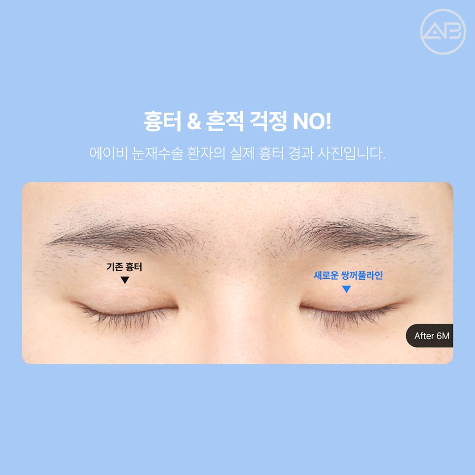 에이비성형외과 쌍꺼풀 짝눈 눈재수술종류 전후 관련 이미지 9