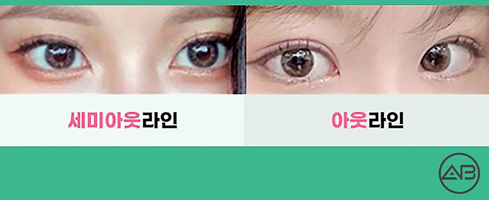 Q. 첫눈수술인데 세미아웃 인아웃의 차이점이 뭔가요? 관련 이미지 3
