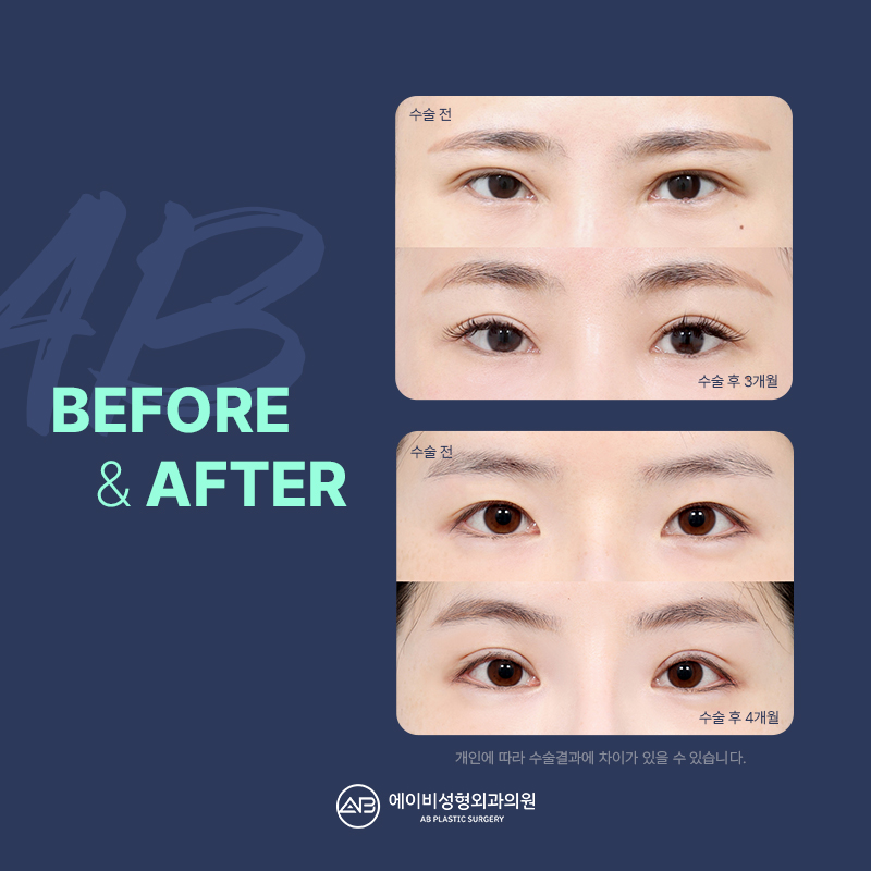 What Is the Endtop Eyebrow Lift That So Many People in Their 20s and 30s Are Getting? image 8