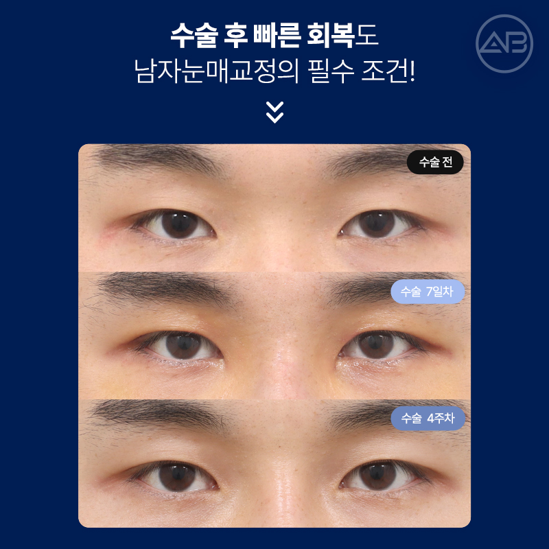 인상을 바꾸는 첫 시작, 에이비성형외과 남자눈성형 관련 이미지 14
