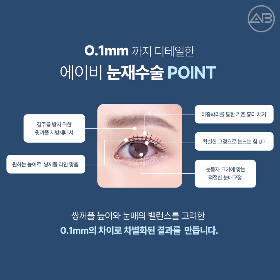 에이비성형외과 쌍꺼풀 짝눈 눈재수술종류 전후 관련 이미지 8