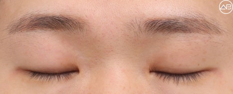AB Plastic Surgery Male Eye Surgery Case Review (Feat. Director Ahn Moon-young) image 7
