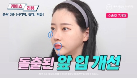 #에이비성형외과#에이비tv#케이스리뷰#윤곽3종수술 관련 이미지 6