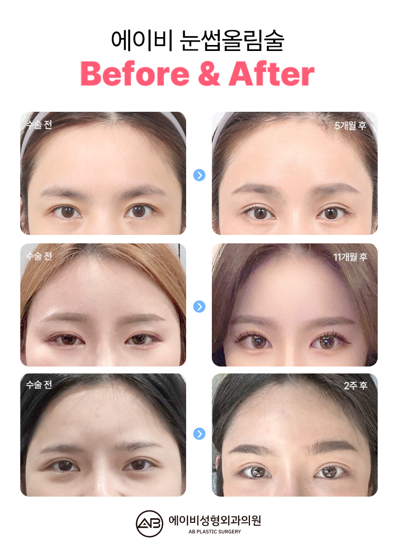 Curious About AB Plastic Surgery’s Brow Lift Surgery? image 4