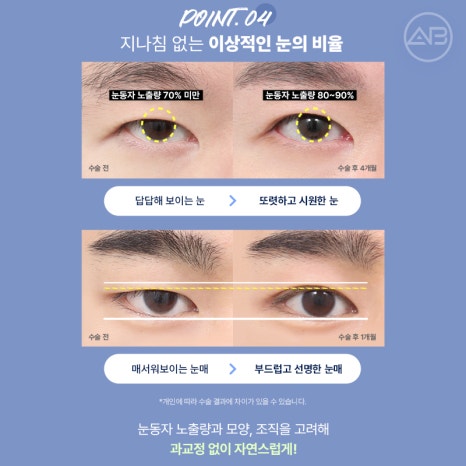 인상을 바꾸는 첫 시작, 에이비성형외과 남자눈성형 관련 이미지 11
