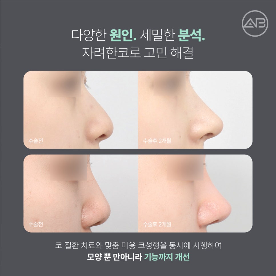 자려한코성형 원한다면 에이비성형외과 관련 이미지 5