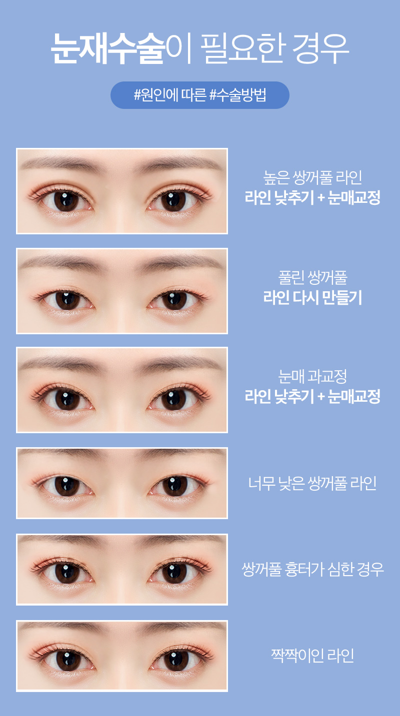 쌍꺼풀재수술잘하는병원 찾고 있다면! AB성형외과! 관련 이미지 2
