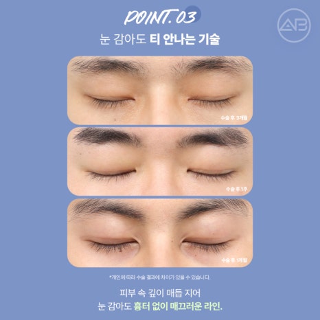 인상을 바꾸는 첫 시작, 에이비성형외과 남자눈성형 관련 이미지 10