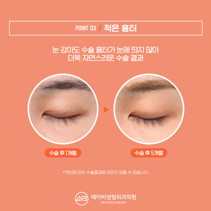 남자눈성형잘하는곳 에이비 라며? 관련 이미지 4