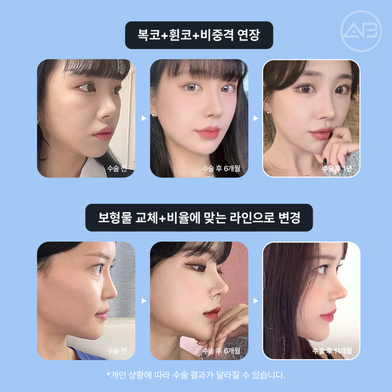 코재수술 필요하다면 에이비성형외과 관련 이미지 14