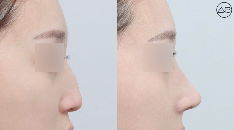 Learn About and Decide on AB Plastic Surgery’s Hump Nose Correction and Implant-Free Rhinoplasty image 2