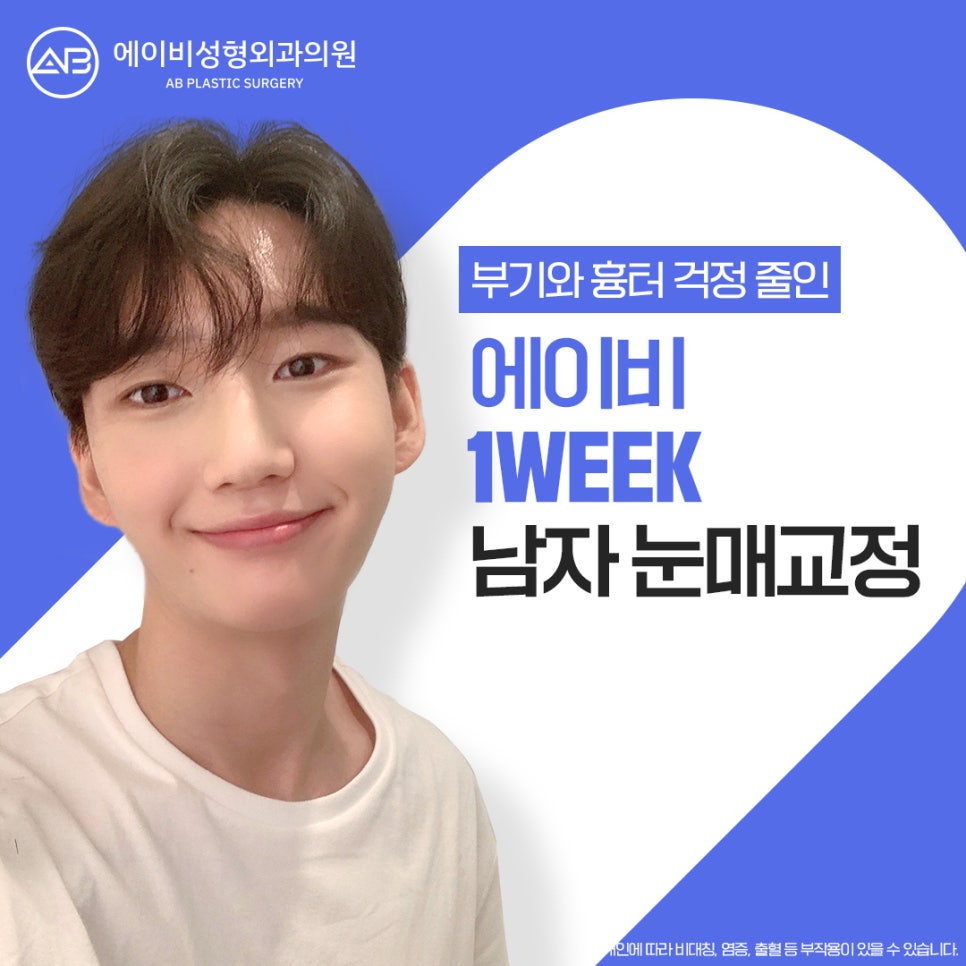 [칼럼] 짝눈인데, 한쪽만 수술받아도 괜찮을까요? 관련 이미지 2