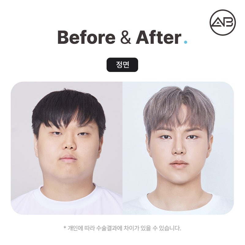 AB Plastic Surgery on MAKE미남 Episode 7 - Looking into the Short Nose Surgery for Gaseum Aen I Nae Namja! image 7