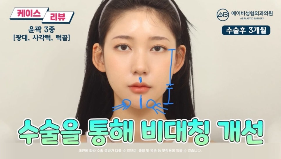 #에이비성형외과#에이비tv#케이스리뷰#안면윤곽성형 관련 이미지 5