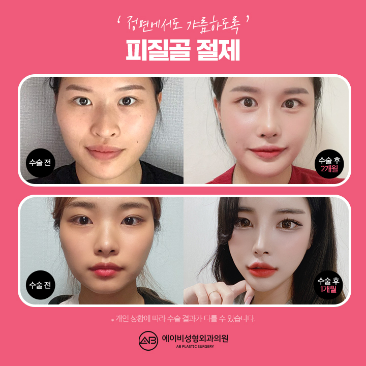 Trust AB Plastic Surgery, the Best Place for Square Jaw Surgery image 5