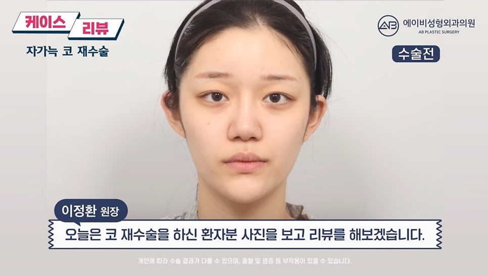 #에이비성형외과#에이비tv#케이스리뷰#코성형#코재수술 관련 이미지 1