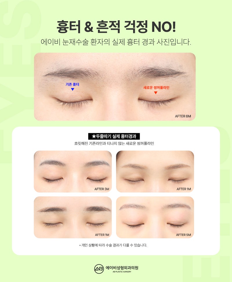 AB Revision Double Eyelid Surgery: What Is Double Folding? image 7