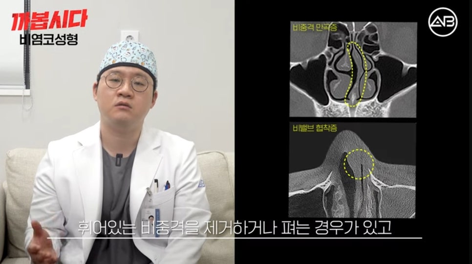 #AB Plastic Surgery #AB TV #Rhinoplasty #Rhinoplasty for Rhinitis image 4