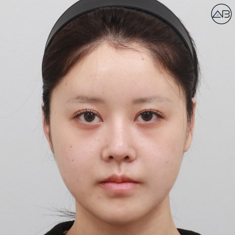 에이비성형외과 양악+윤곽수술(사각턱 턱끝) 케이스 리뷰 관련 이미지 2