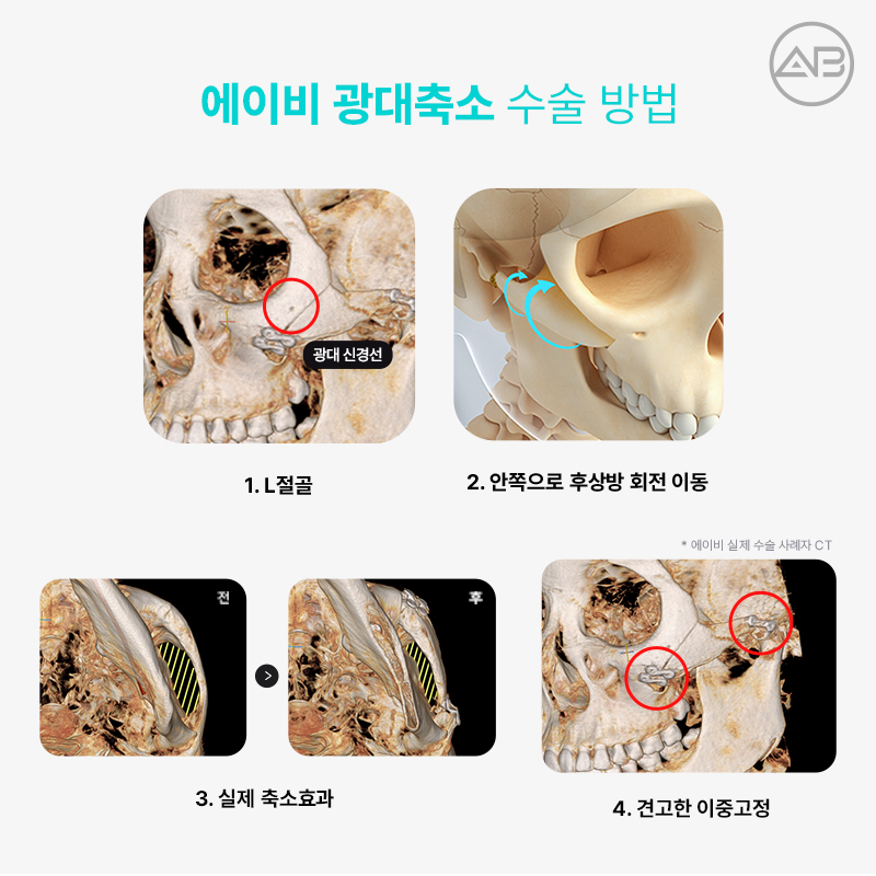 에이비성형외과 광대축소 부드럽고 갸름하게 관련 이미지 4