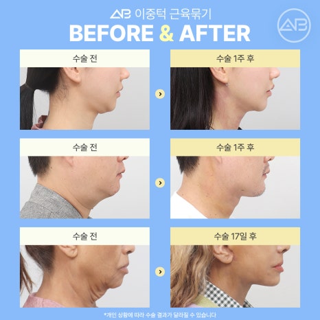 The Secret to a Slim Jawline, AB Plastic Surgery Double Chin Muscle Binding image 8