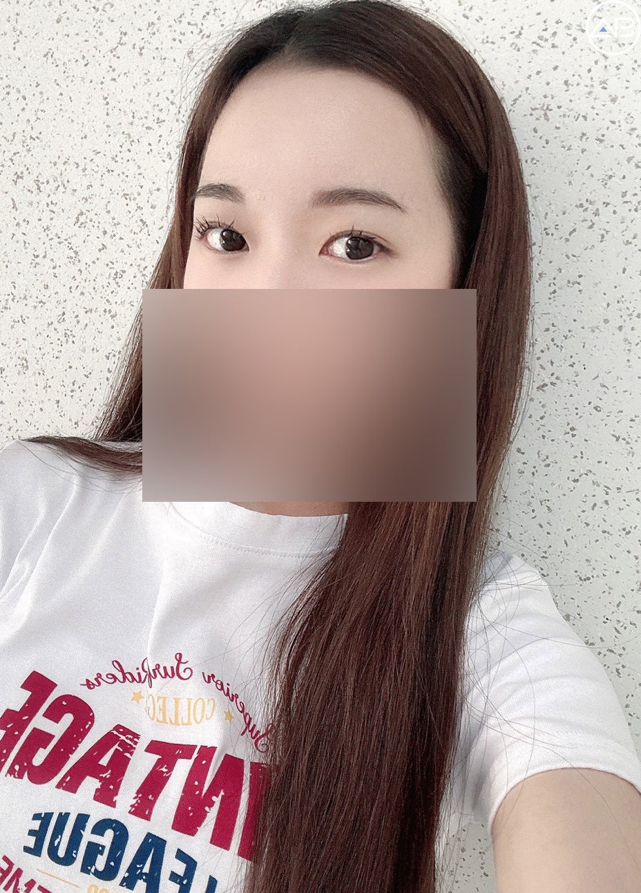 여자 비절개눈매교정 케이스리뷰(Feat.안문영원장) 관련 이미지 3
