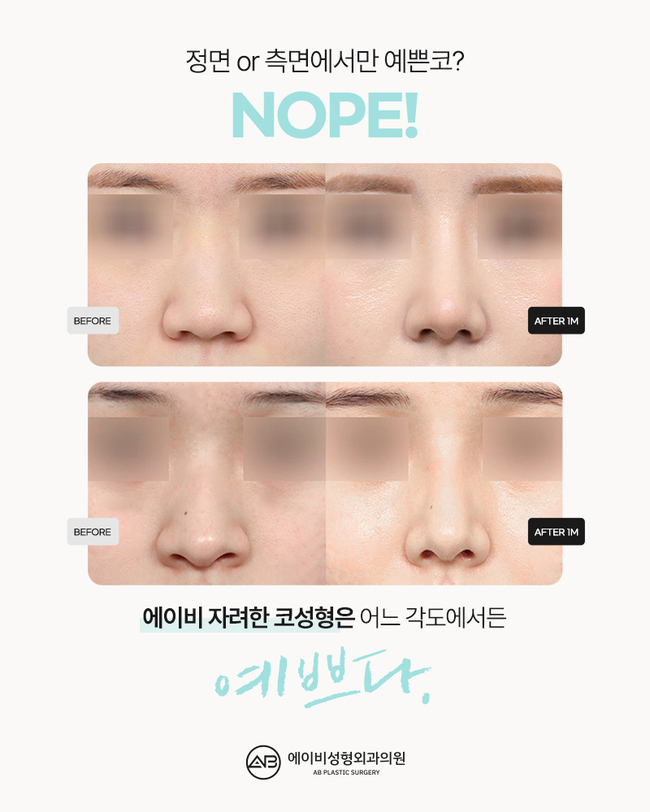 AB Plastic Surgery’s Glamorous Nose Surgery POINT image 4