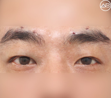 Severe Ptosis: Which Surgery Is Effective? image 4