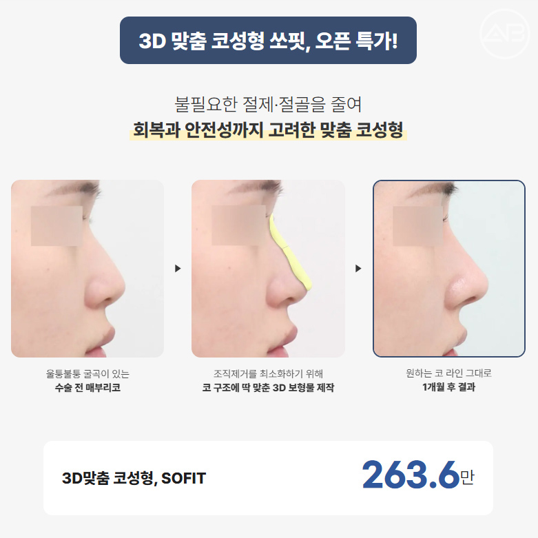 에이비성형외과 추석 기획전 눈밑, 3D 맞춤코성형 이벤트 관련 이미지 3