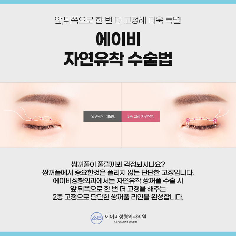 쌍꺼풀수술 자연유착 매몰법 VS 절개법 차이 관련 이미지 4