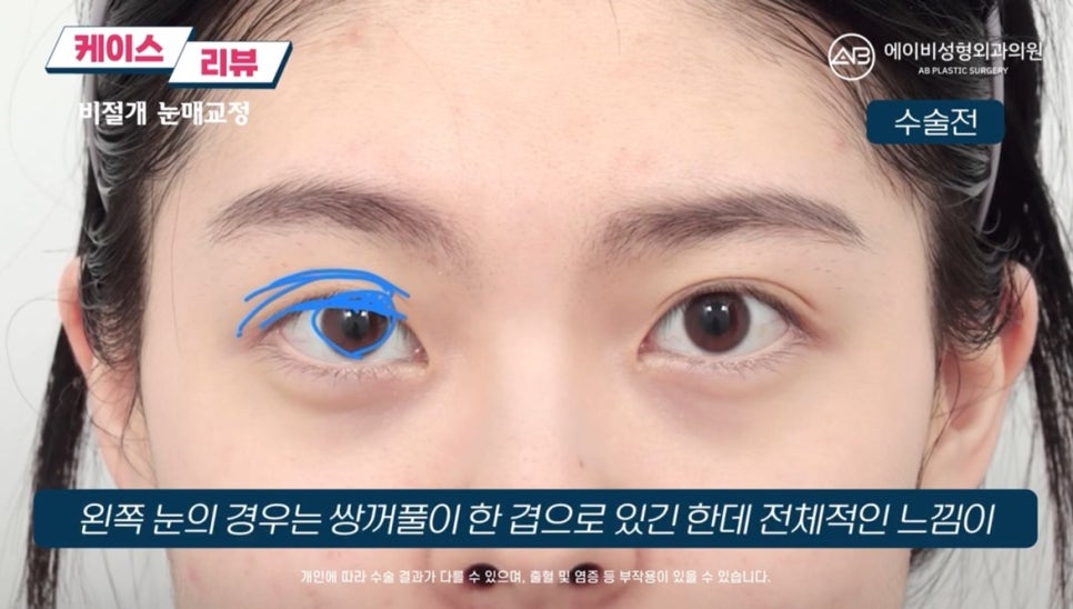 #AB Plastic Surgery #AB TV #Eye Surgery #Non-Incisional Ptosis Correction image 2