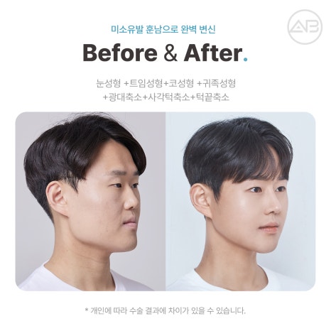 에이비성형외과 맥미남(MAKE미남)9회 - 민원유발내남자 짧은코수술, 매부리코수술 알아보기! 관련 이미지 10