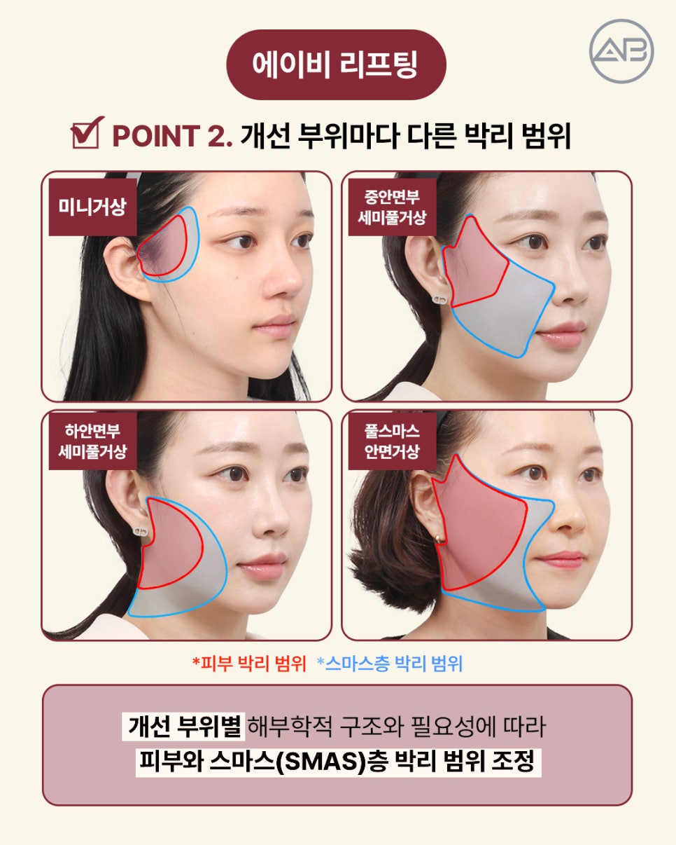 AB Plastic Surgery: Aging-Specific Step-by-Step Lifting (Mini Lift, Semi-Full Lift, Full SMAS Facelift) image 6