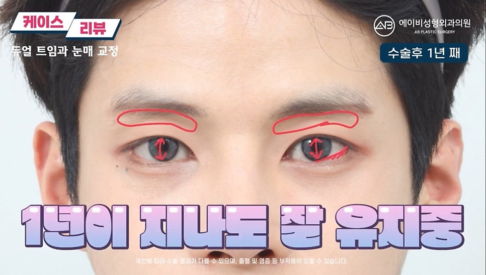 #에이비성형외과#에이비tv#눈성형#남자눈성형 관련 이미지 8