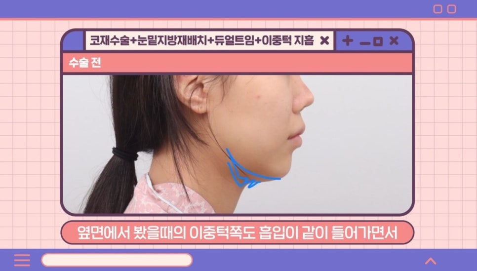 #AB Plastic Surgery #AB TV ##Case Review #Eye Surgery #Nose Revision Surgery image 3