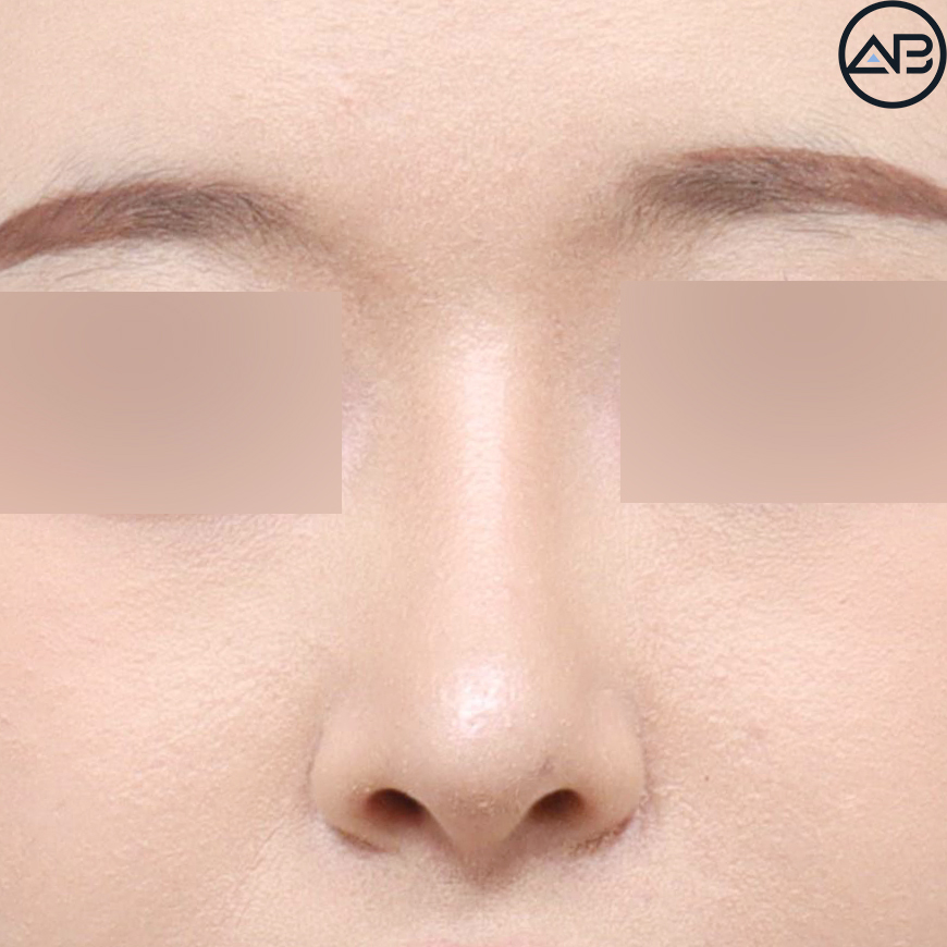 에이비성형외과 자려한코성형 - 첫코 케이스 리뷰 관련 이미지 3