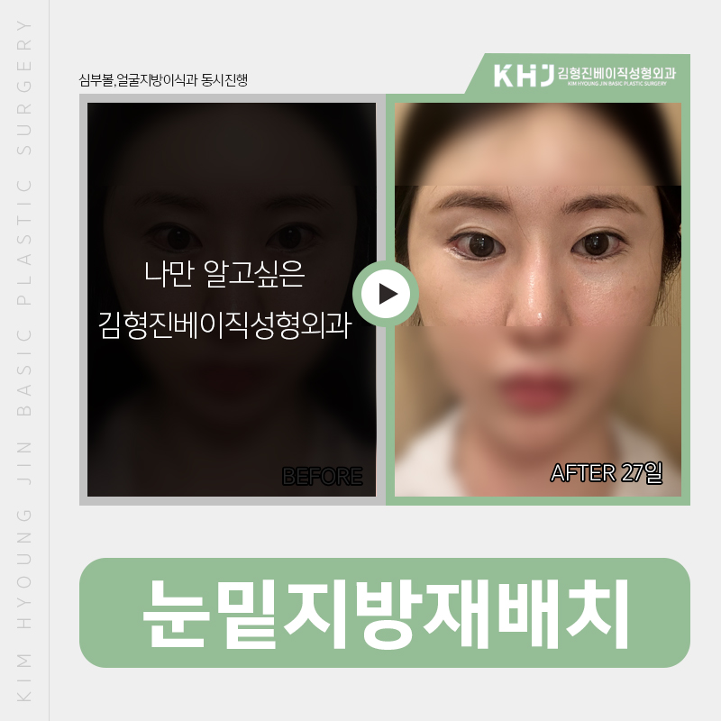 눈밑다크서클 걱정하실필요 없어요! 관련 이미지 3