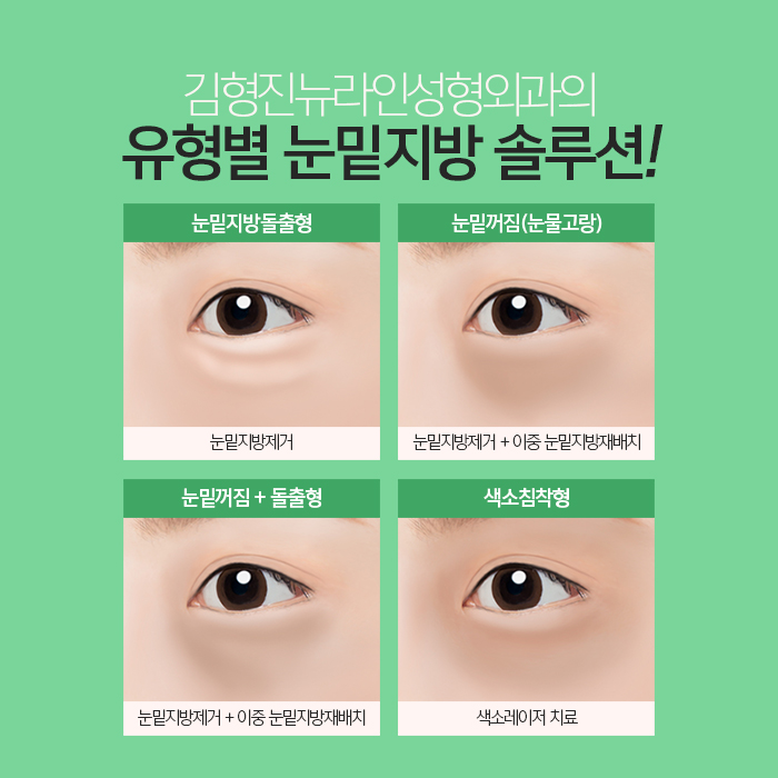 눈밑지방재배치멍 걱정? 김형진원장이라면 관련 이미지 3