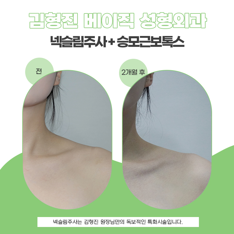 넥슬림주사전후 목부터 어깨까지! 완벽한 라인을 만드는 방법 관련 이미지 5