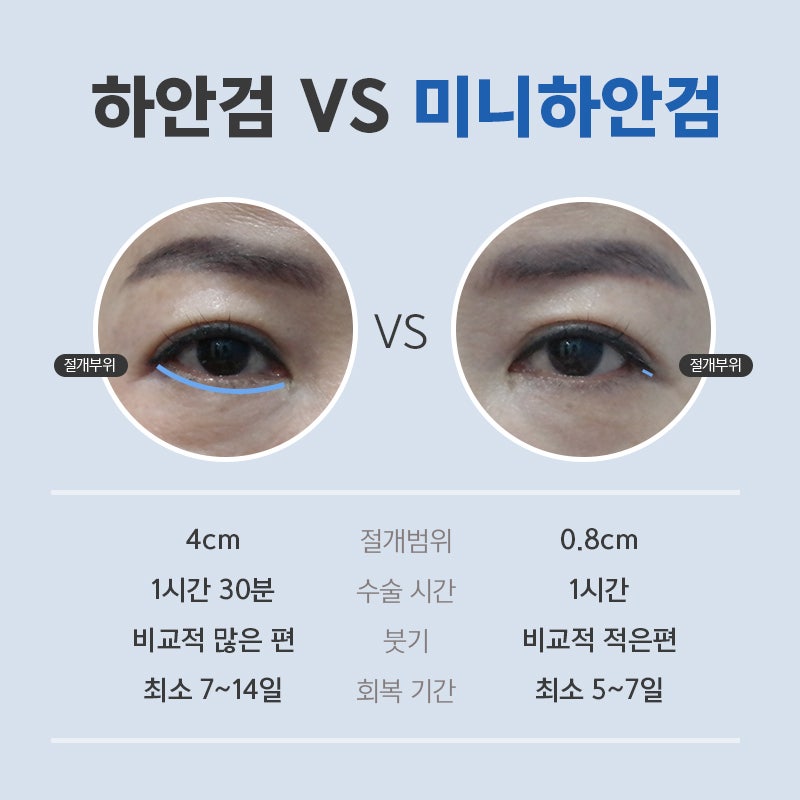 미니하안검붓기 걱정하지마세요! 관련 이미지 3