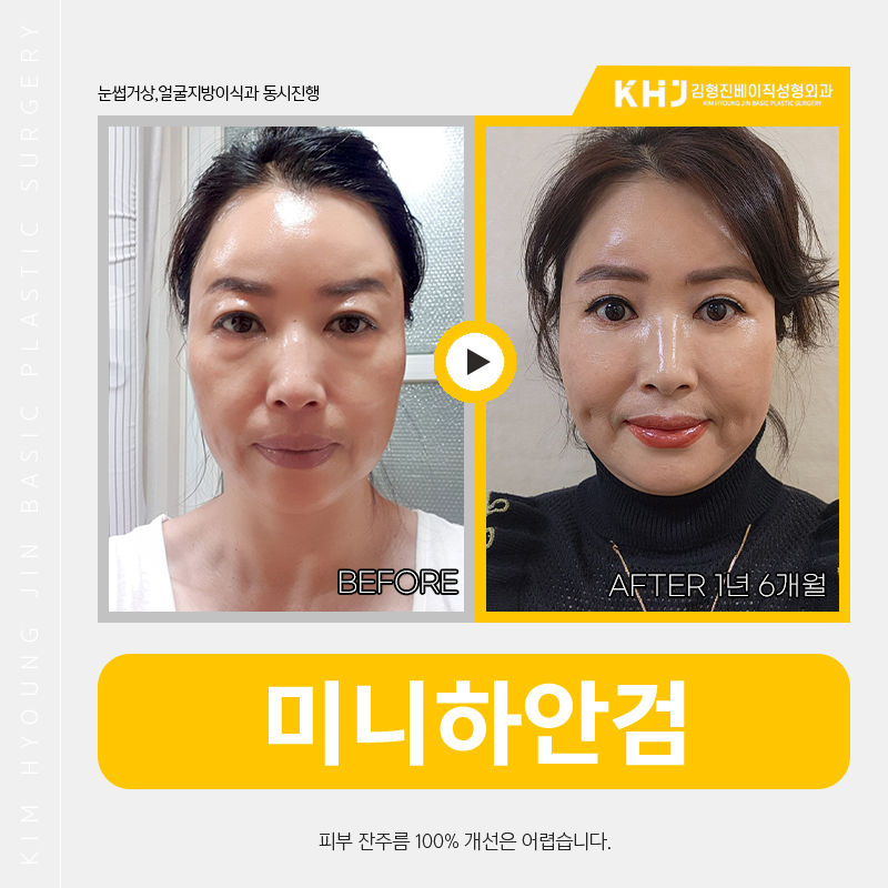 미니하안검전후 비교해보고 결정하세요! 관련 이미지 6