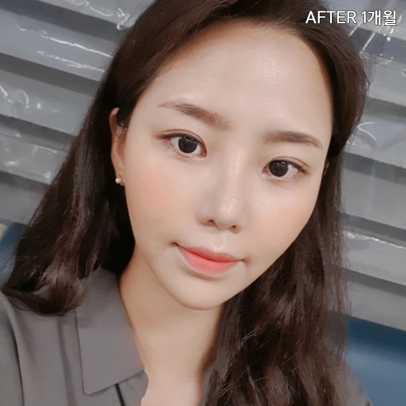 김형진베이직 얼굴지흡효과 좋다 좋아 관련 이미지 6